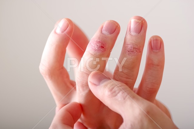 指先のアトピーが痛そうな手